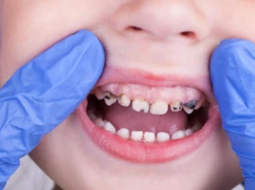 Cavity Treatment In Pune