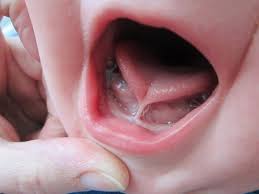 Tongue Tie Treatment in pune​