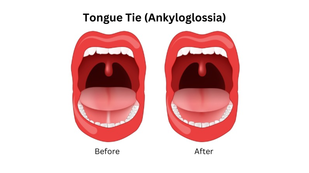 Tongue Tie Pune