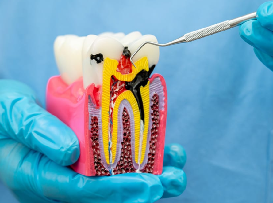 root canal treatment in Pune | root canal surgery in Pune | Dr. Abhay Bhosale