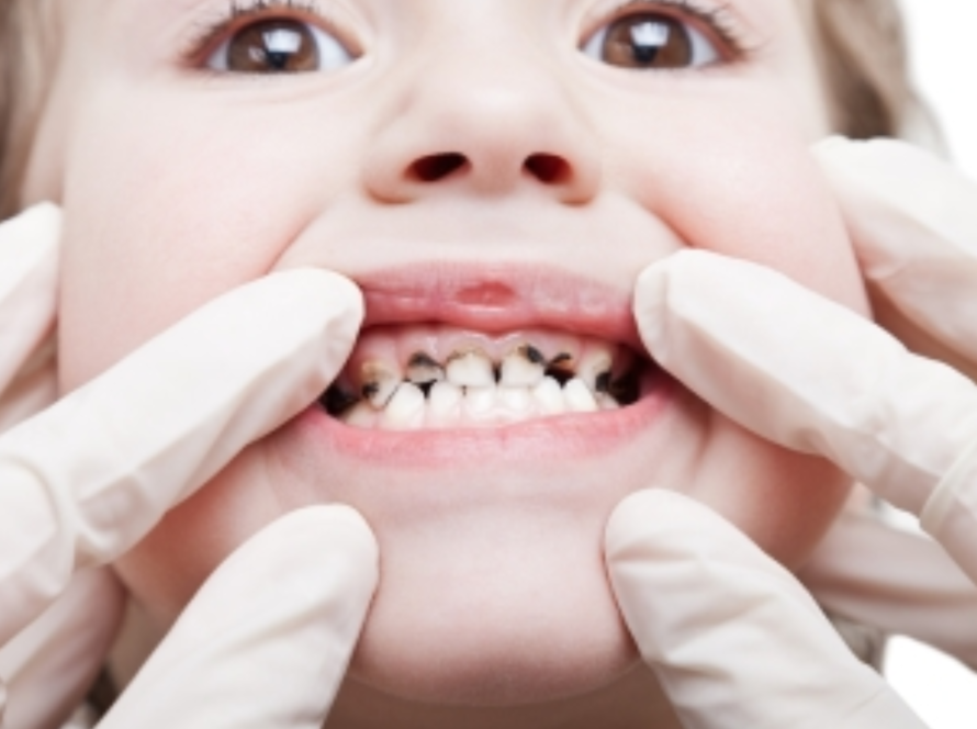 Root Canal Vs Tooth Extraction treatment in Pune